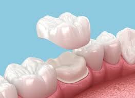 Dental Crowns